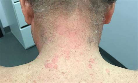 Prikaz majhne luknjice na koži nad trtico