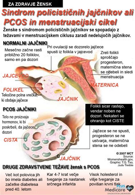 Diagram, ki prikazuje značilnosti PCOS: policistični jajčniki, neredne menstruacije, akne, poraščenost, debelost.