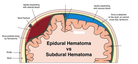 Diagram subhorionskega hematoma