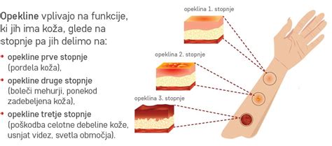 Različne stopnje opeklin na koži