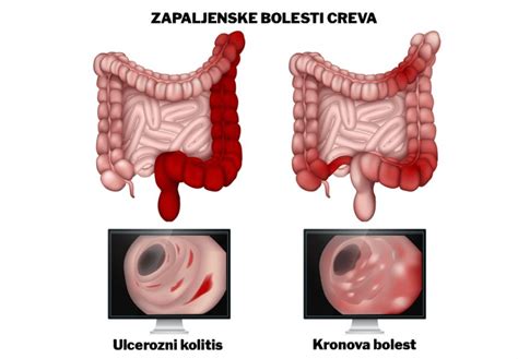 Diagram črevesnih bolezni, kot sta Chronova bolezen in ulcerozni kolitis