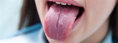 Beli oblogi na jeziku dojenčka