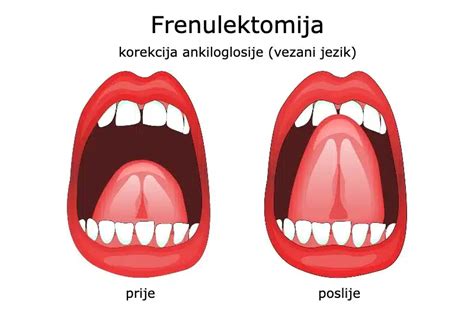 Diagram ankiloglosije