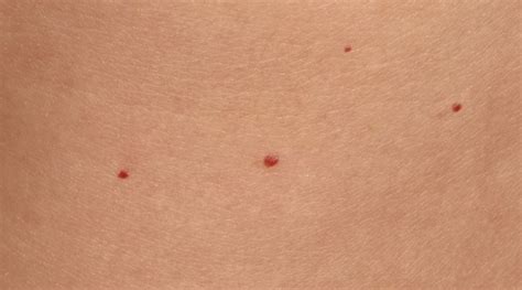 dojenček z rdečo piko na koži