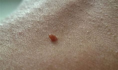 laser, ki deluje na kožno znamenje