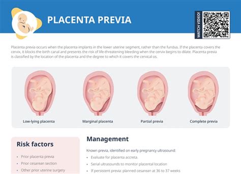 Diagram prikazuje položaj posteljice ob placenta previa
