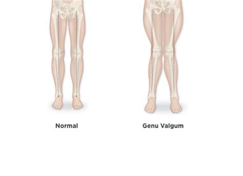 Diagram, ki prikazuje normalno poravnavo nog in genu valgum (hoja na X).
