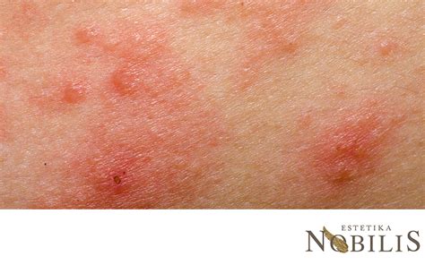 različne kožne spremembe na dojkah