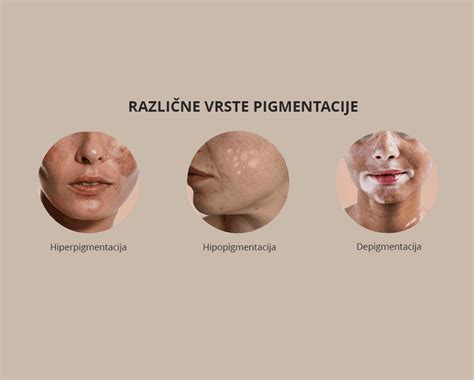 Različne vrste pigmentacij na obrazu