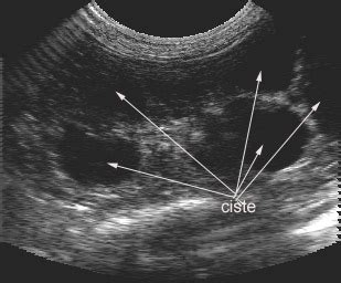 Ultrazvočni posnetek ledvic otroka