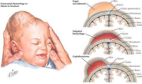 Shematski prikaz caput succedaneuma in kefalohematoma