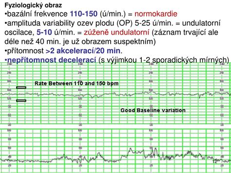 Kardiotokogram (CTG)