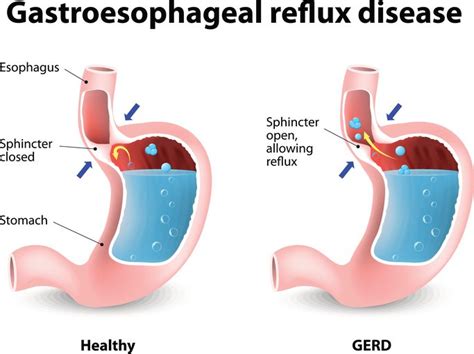 diagram gastroezofagealnega refluksa