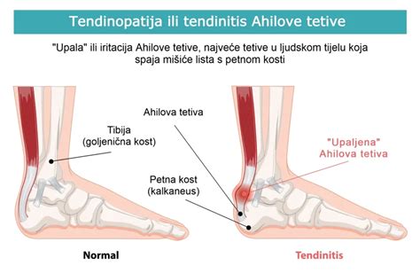 Diagram Ahilove tetive in mečnih mišic.