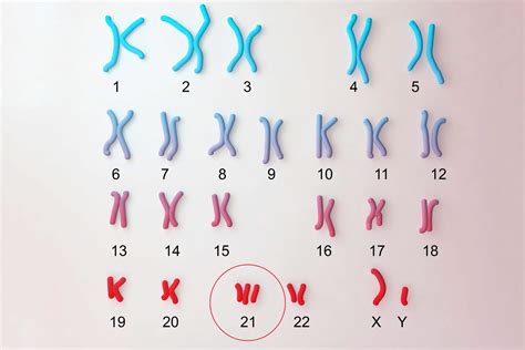 Shematični prikaz trisomije 21