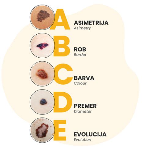 Infografika, ki ponazarja pravilo ABCDE za prepoznavanje sumljivih kožnih znamenj.
