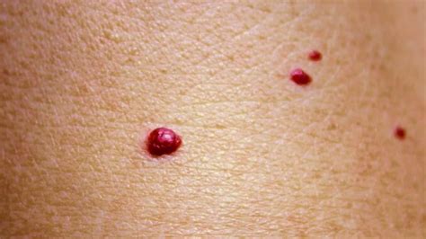 Diagram, ki prikazuje, kako se angiom razlikuje od nevarnega kožnega znamenja