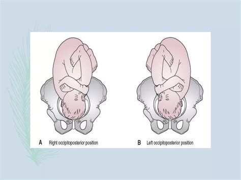 Prikaz idealnega porodnišnega položaja ploda (occipito anterior)