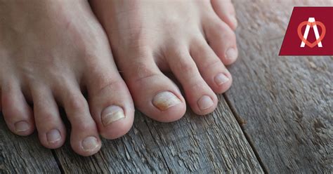 glivična okužba nohta