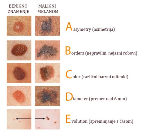 Različne vrste pigmentnih znamenj na koži