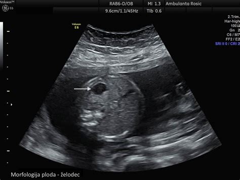 Ultrazvočni prikaz ploda v maternici z ustrezno količino plodovnice