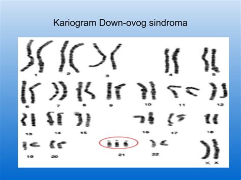 Diagram prikazuje kromosomske pari pri Downovem sindromu
