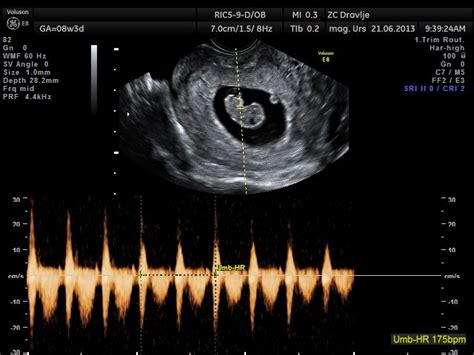 Ultrazvočni prikaz hematoma v nosečnosti