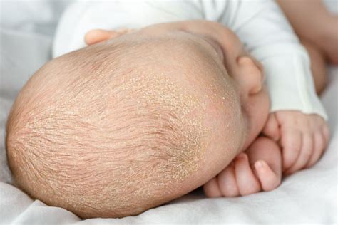 Slika otroka s seboroičnim dermatitisom na lasišču