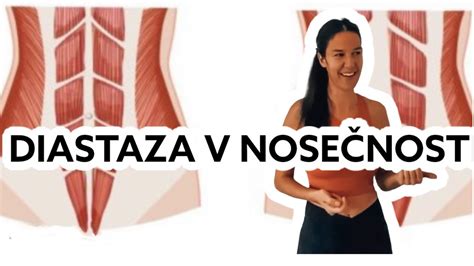 Diagram prikazuje razmik trebušnih mišic (diastasis recti)