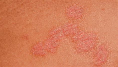 glivični izpuščaj na ritki dojenčka