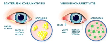 infografika primerjava virusnega in bakterijskega konjunktivitisa