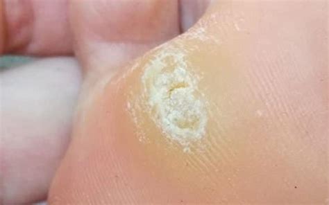 Diagram prikazuje proces krioterapije bradavic s tekočim dušikom, vključno z nizko temperaturo in učinkom na celice bradavice.