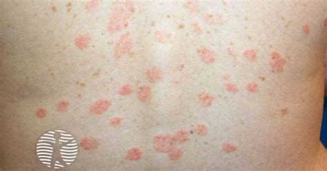 Mapa telesa z označenimi tipičnimi predeli pojava pityriasis rosea