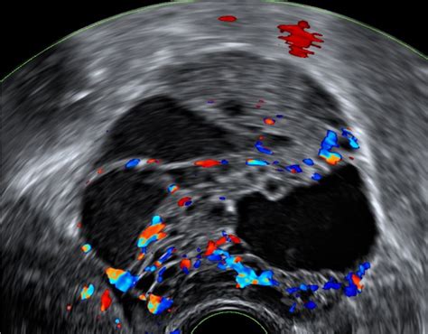 Ultrazvočni prikaz jajčnikov z antralnimi folikli