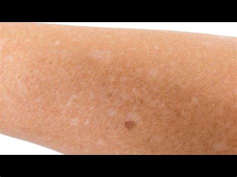 Madež barve bele kave na koži