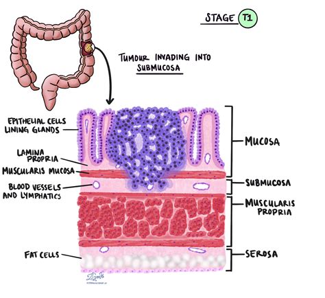 Grafični prikaz debelega črevesa z območji vnetja zaradi ulceroznega kolitisa