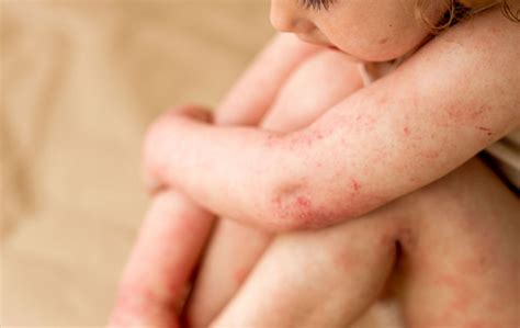 Dojenček z atopijskim dermatitisom na obrazu