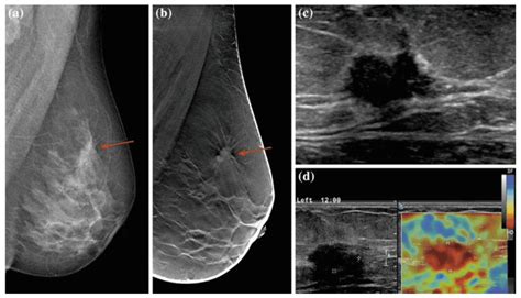 Diagram, ki prikazuje potek punkcije dojke