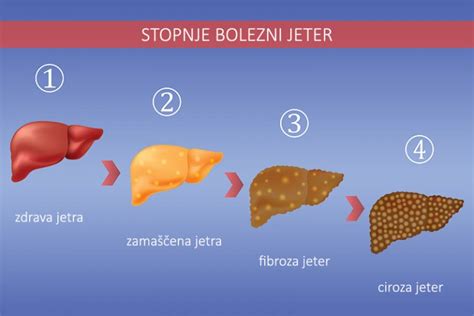 Shematski prikaz vzrokov za bolezni jeter