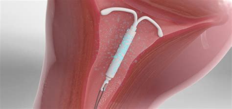 Diagram delovanja intrauterini sistem Mirena