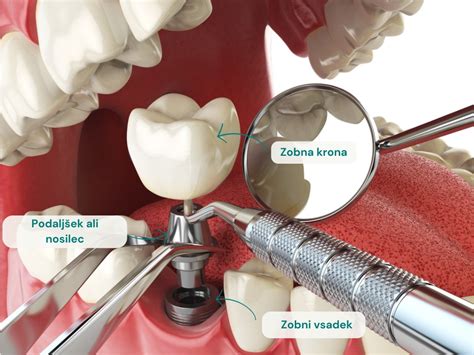 Diagram zobne krone in korenine
