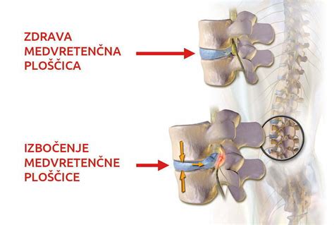 Diagram pravilne in nepravilne drže hrbtenice