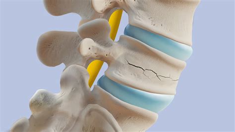 zlomljena hrbtenica dojenčka