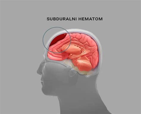 Ultrazvočni prikaz subhorionskega hematoma