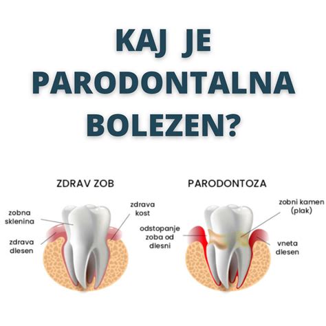 Ilustracija zdravega zoba in zoba, ki ga prizadene karies