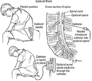 Diagram namestitve epiduralnega katetra