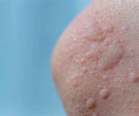 Roka z izpuščaji, ki se maže s kremo