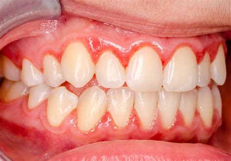 Prikaz vnetja dlesni (gingivitis)