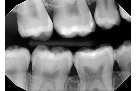 Slika zoba, ki je bil zlomljen