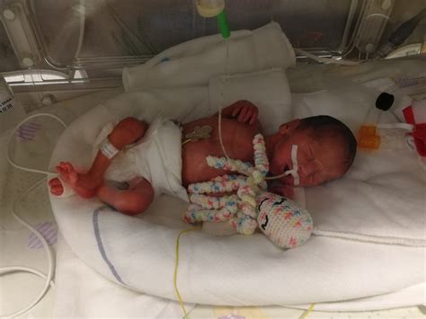 nedonošenček v inkubatorju